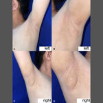 Filipinli kadının koltuk altından süt sızdı: Nadir görülen bu durumun nedeni nedir?