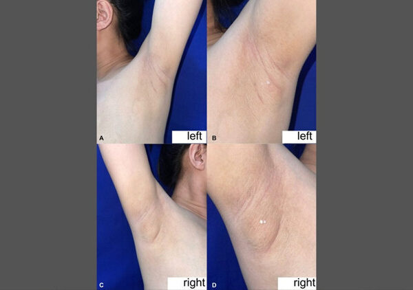 Filipinli kadının koltuk altından süt sızdı: Nadir görülen bu durumun nedeni nedir?