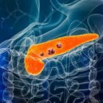 Pankreas Kanseri İçin Umut Verici İlerlemeler: ‘Yaşam Süresi Yüzde 54’e Çıktı’